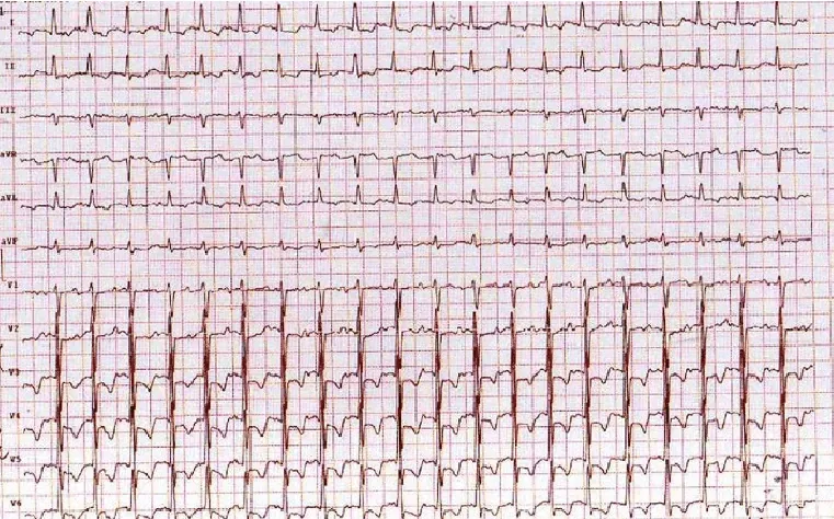 Exercise-ECG-stress-test-shows-ST-segment-depression-on-anterolateral-leads