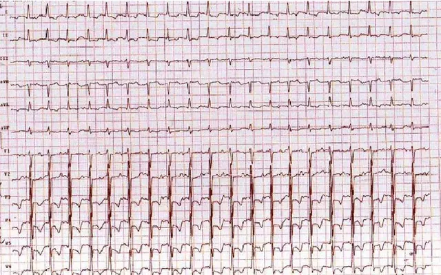 Exercise-ECG-stress-test-shows-ST-segment-depression-on-anterolateral-leads
